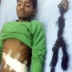 Doctors Discover Rare ‘Parasitic Twin’ Inside Teenager’s Abdomen After 18 Years