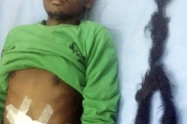 Doctors Discover Rare ‘Parasitic Twin’ Inside Teenager’s Abdomen After 18 Years