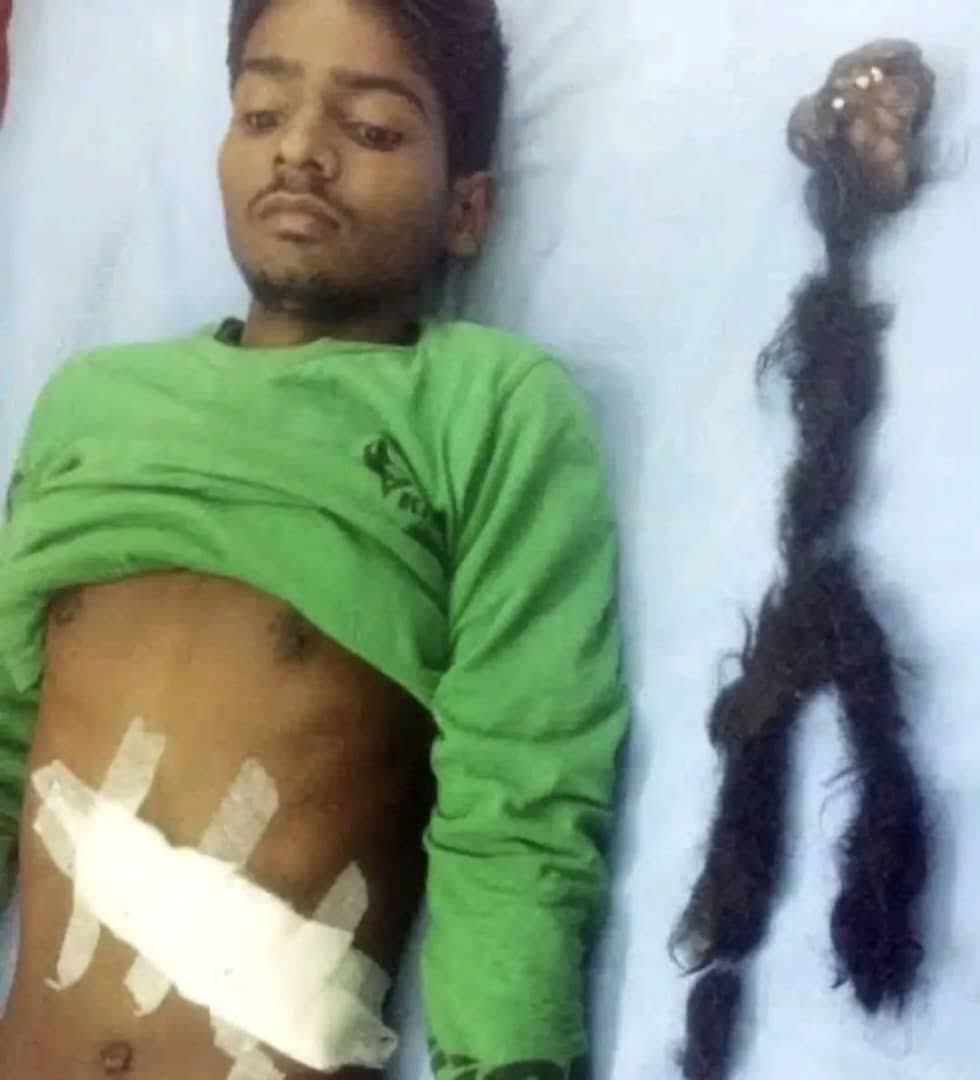 Doctors Discover Rare ‘Parasitic Twin’ Inside Teenager’s Abdomen After 18 Years
