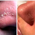 Sebaceous filaments