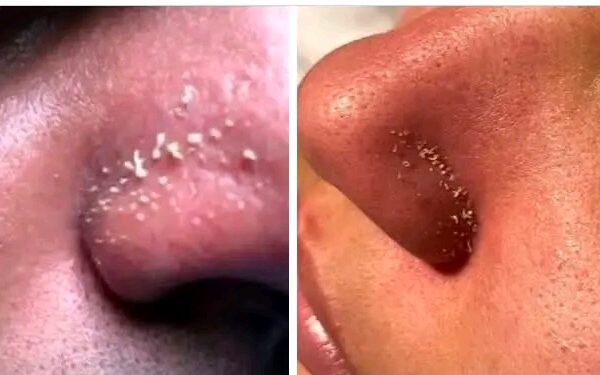 Sebaceous filaments