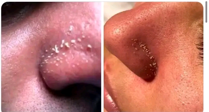 Sebaceous filaments